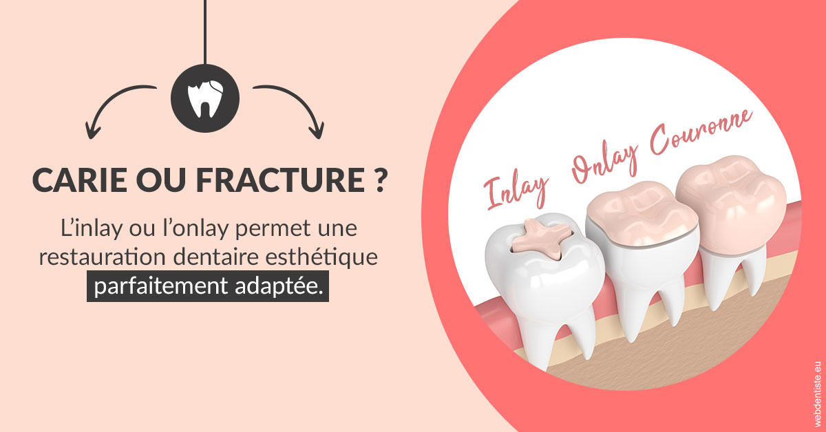 https://dr-mauro-fabien.chirurgiens-dentistes.fr/T2 2023 - Carie ou fracture 2