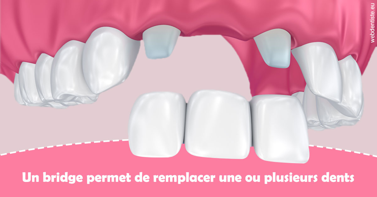 https://dr-mauro-fabien.chirurgiens-dentistes.fr/Bridge remplacer dents 2