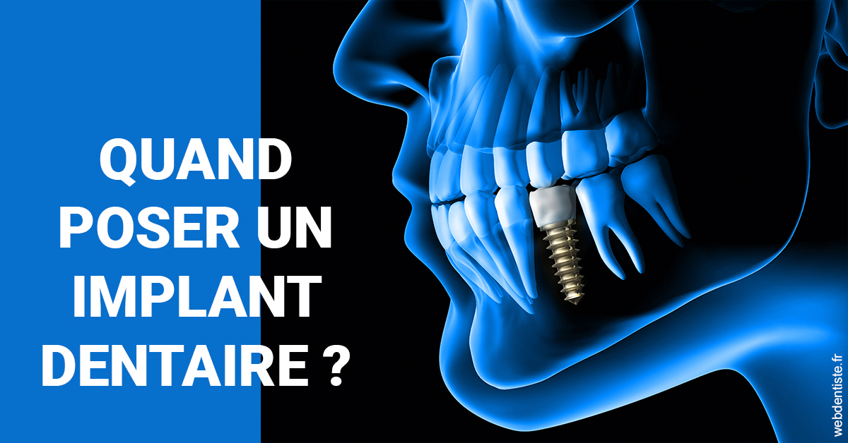 https://dr-mauro-fabien.chirurgiens-dentistes.fr/Les implants 1