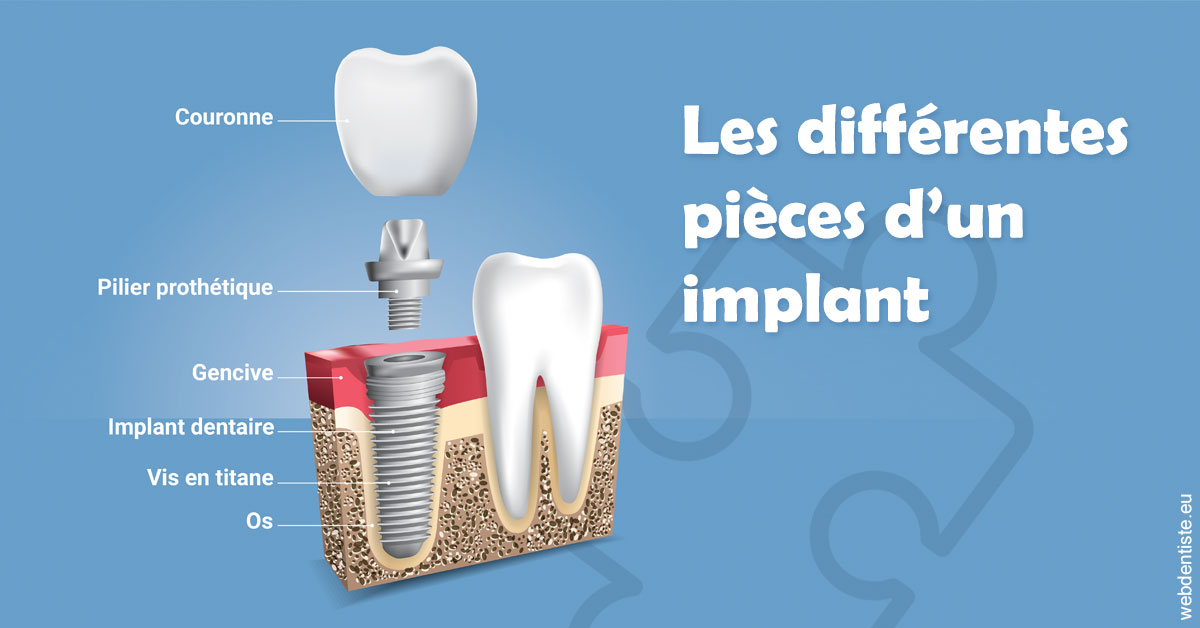 https://dr-mauro-fabien.chirurgiens-dentistes.fr/Les différentes pièces d’un implant 1